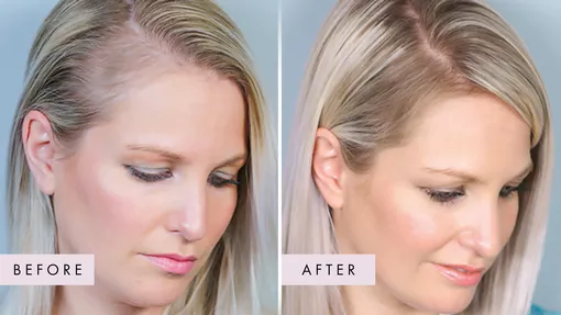 Kimberley-Coke before and after using Hair Gain Gummies