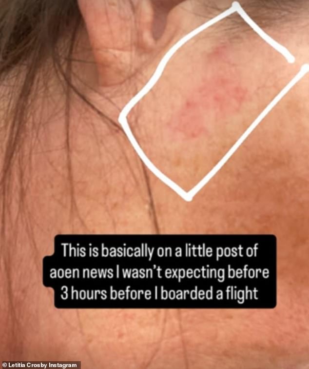 Letitiia shared an up-close image of the side of her face with the caption over the top reading: 'This is basically on a little post of aoen news I wasn't expecting before I 3 hours before I boarded a flight [sic]'