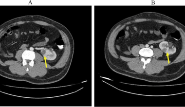 Segmental spleen and left kidney infarction induced by vasoconstriction in a methamphetamine abuser patient: a case report | International Journal of Emergency Medicine