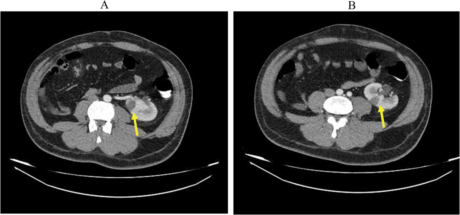 Segmental spleen and left kidney infarction induced by vasoconstriction in a methamphetamine abuser patient: a case report | International Journal of Emergency Medicine