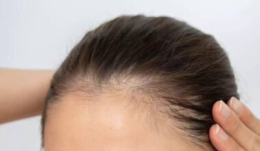 6 essential nutrients that may slow down premature hair thinning