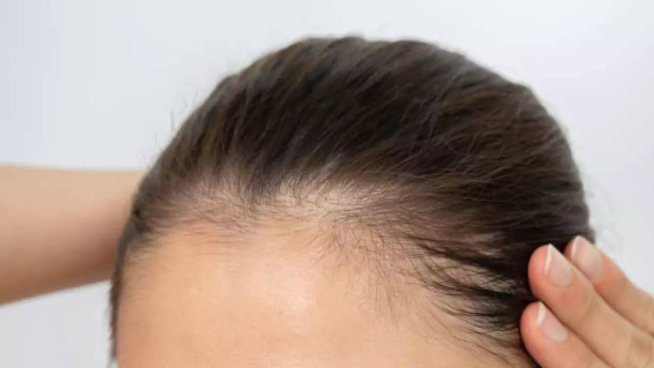 6 essential nutrients that may slow down premature hair thinning