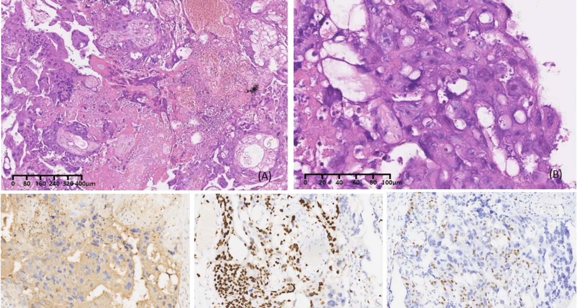 Intraplacental choriocarcinoma in a term pregnancy with massive fetomaternal hemorrhage: a case report | BMC Pregnancy and Childbirth