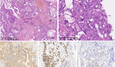 Intraplacental choriocarcinoma in a term pregnancy with massive fetomaternal hemorrhage: a case report | BMC Pregnancy and Childbirth
