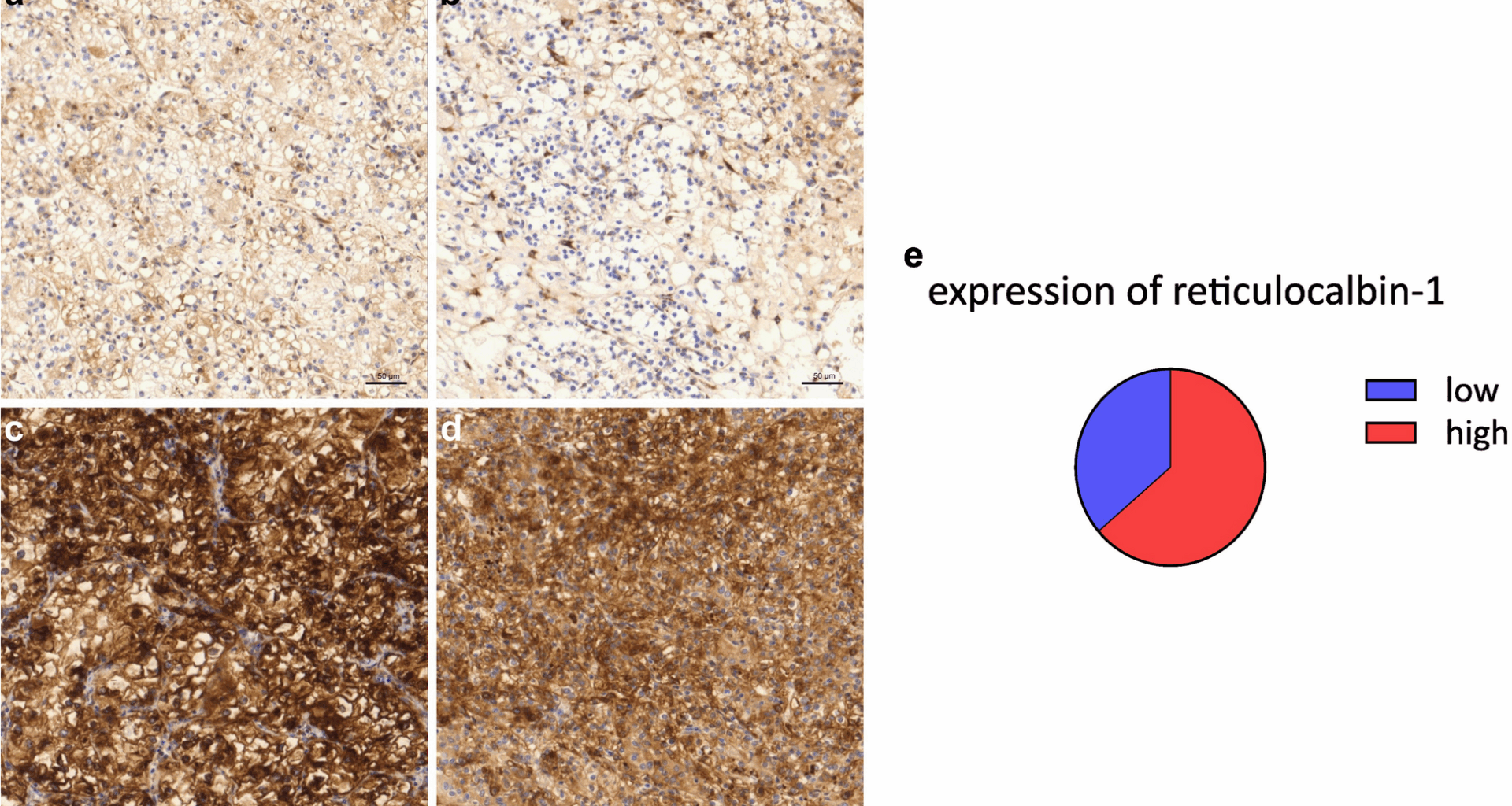 Reticulocalbin-1 in clear cell renal cell carcinoma: clinical and functional evidence for its role as a biomarker and potential therapeutic target | BMC Cancer