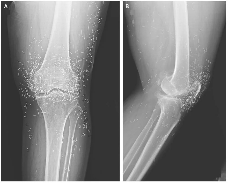  An X-ray image of a patient's knees reveals acupuncture needles left in the tissue. 
