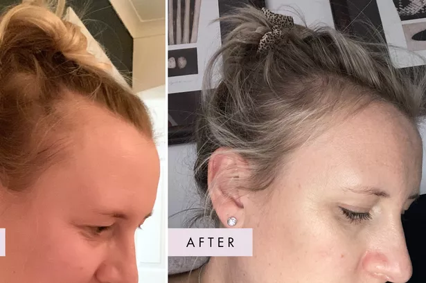 Rachel before and after using Hair Gain Gummies