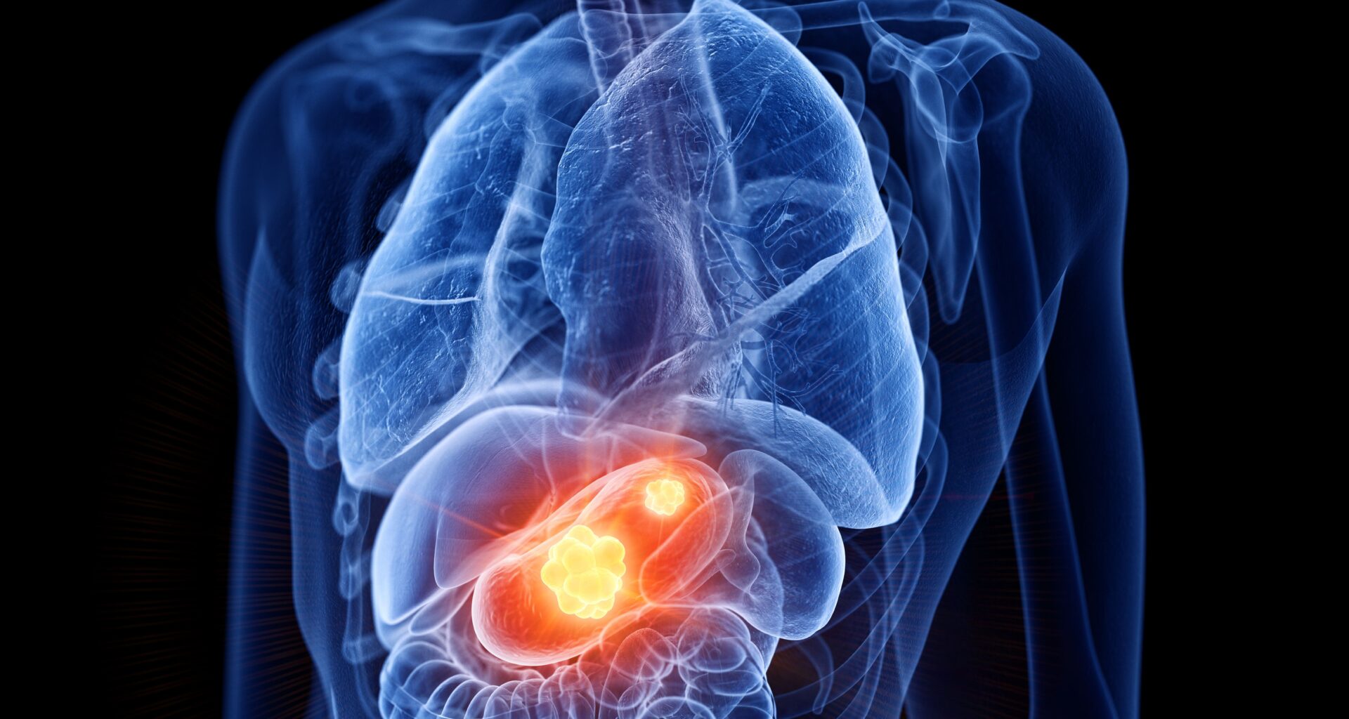 Exosomal Liquid Biopsy Shows High Accuracy for Early Gastric Cancer Detection