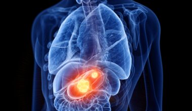 Exosomal Liquid Biopsy Shows High Accuracy for Early Gastric Cancer Detection