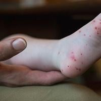 Hamilton County sees uptick in Hands, Foot, and Mouth Disease as kids return to school | Local News