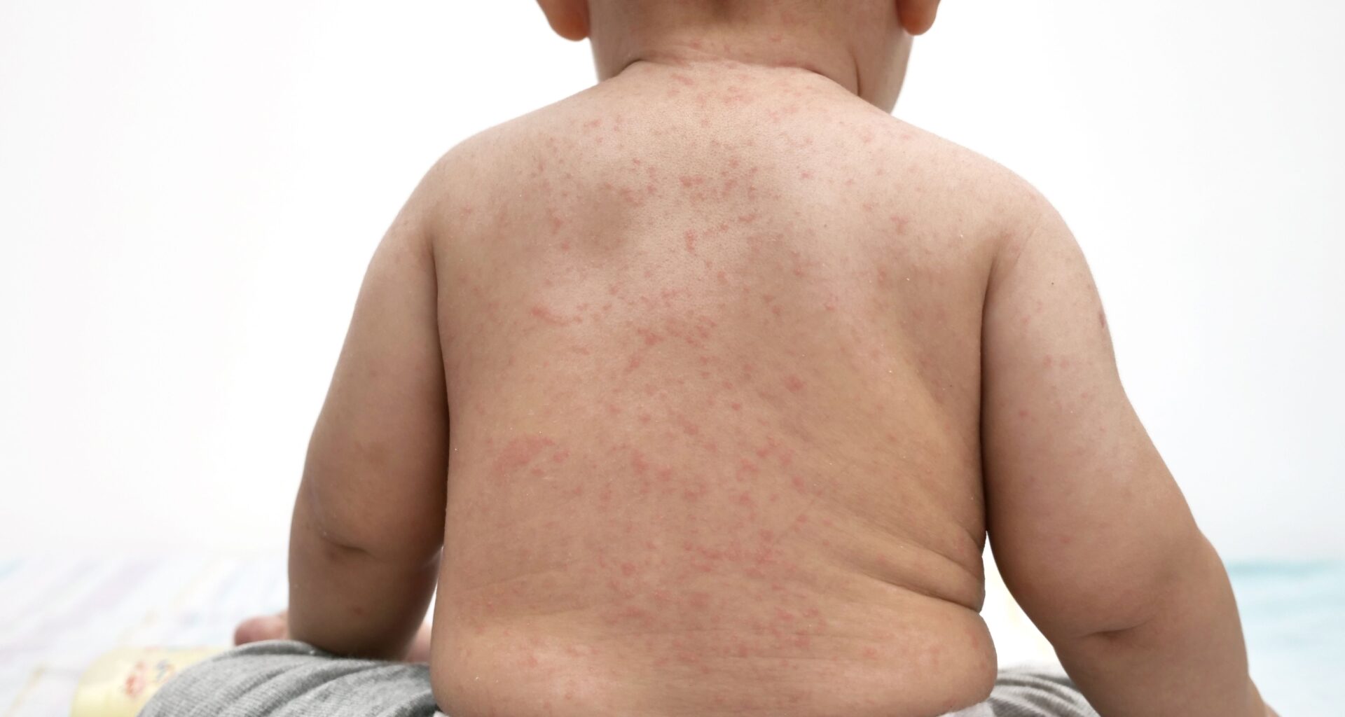 Los Angeles Reports Fatal Case of a Rare Measles Complication Years After Infection