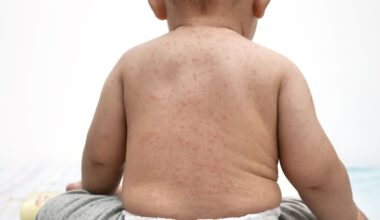 Los Angeles Reports Fatal Case of a Rare Measles Complication Years After Infection