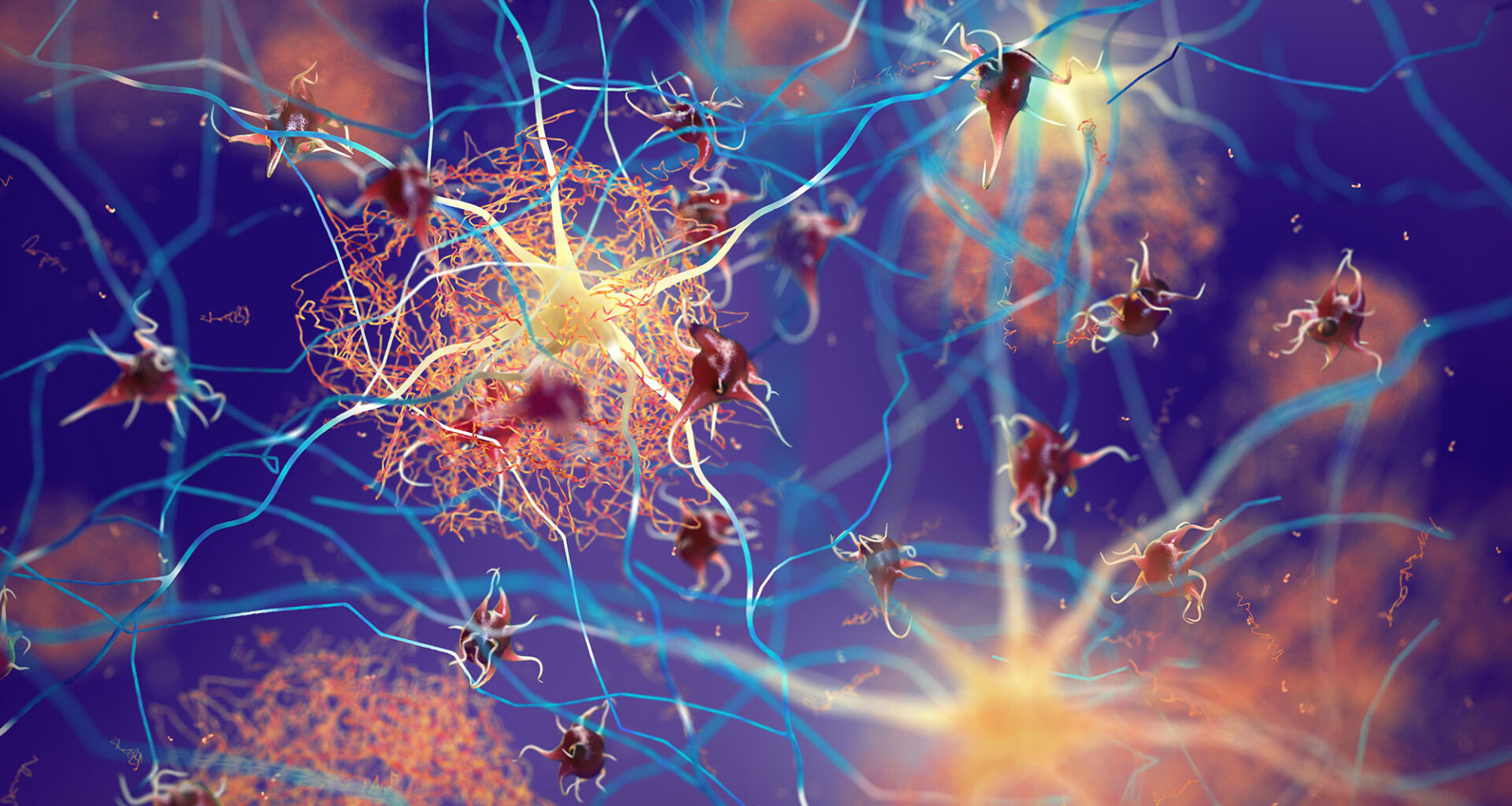 Amyloid Plaques Neurons Alzheimer