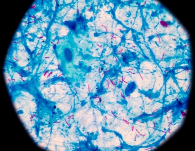 HIV protein Tat found to increase vulnerability to tuberculosis