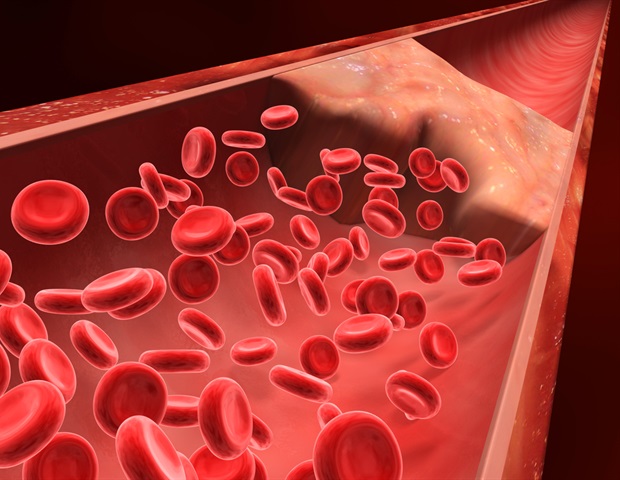 Extended apixaban therapy lowers recurrent VTE in patients with provoked events and enduring risk factors