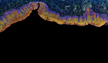 Study identifies C1orf122 as prognostic marker in liver cancer