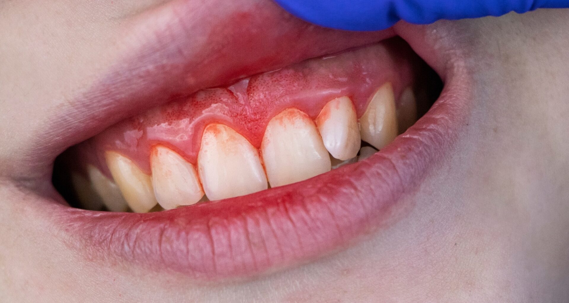 Periodontitis is often known as
