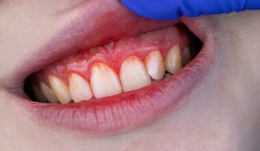 Periodontitis is often known as