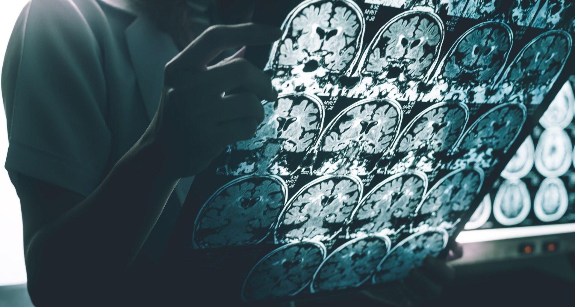 Study: Plasma Phosphorylated Tau 217 to Identify Preclinical Alzheimer Disease. Image Credit: Atthapon Raksthaput / Shutterstock