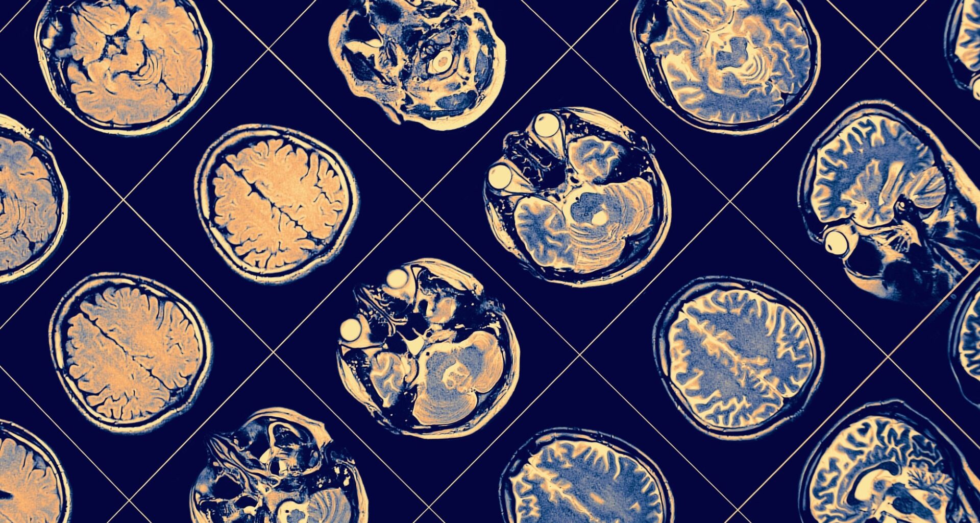 New landscape of the diagnosis of Alzheimer
