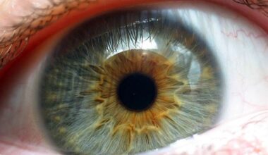 New research aims to use eyedrops to lower lifetime risk of nearsightedness complications