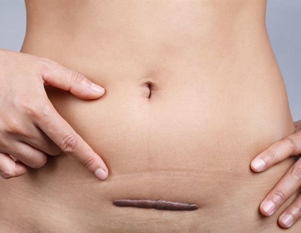 Study links hysterectomy and bilateral oophorectomy to higher stroke risk