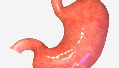 New molecular signatures map the stepwise development of gastric cancer