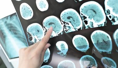 Living in food deserts linked to higher stroke and death risk in atrial fibrillation patients