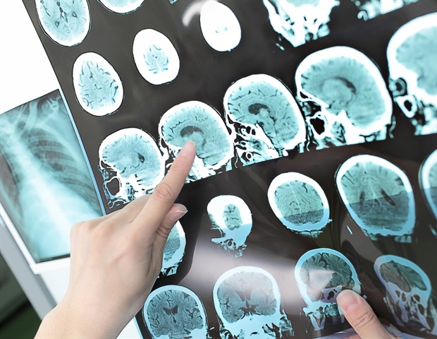 Living in food deserts linked to higher stroke and death risk in atrial fibrillation patients