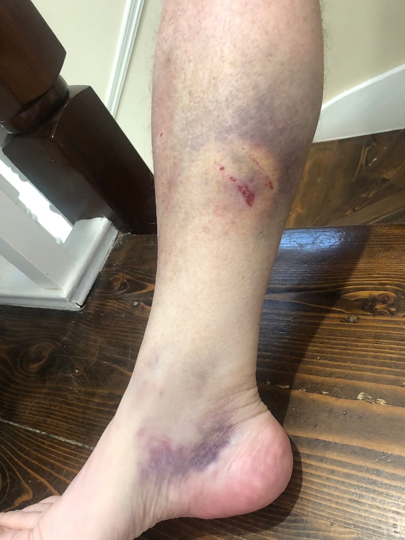 Injuries Cllr Tania Doyle sustained in an attack in Blanchardstown