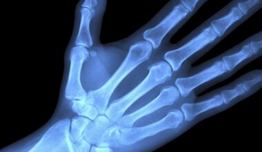 Microplastics Found Deep Inside Human Bones, Scientists Warn : ScienceAlert