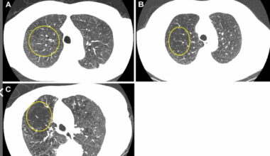 Emphysema on Chest CT Linked to Threefold Higher Risk for COPD Mortality in Next 25 Years