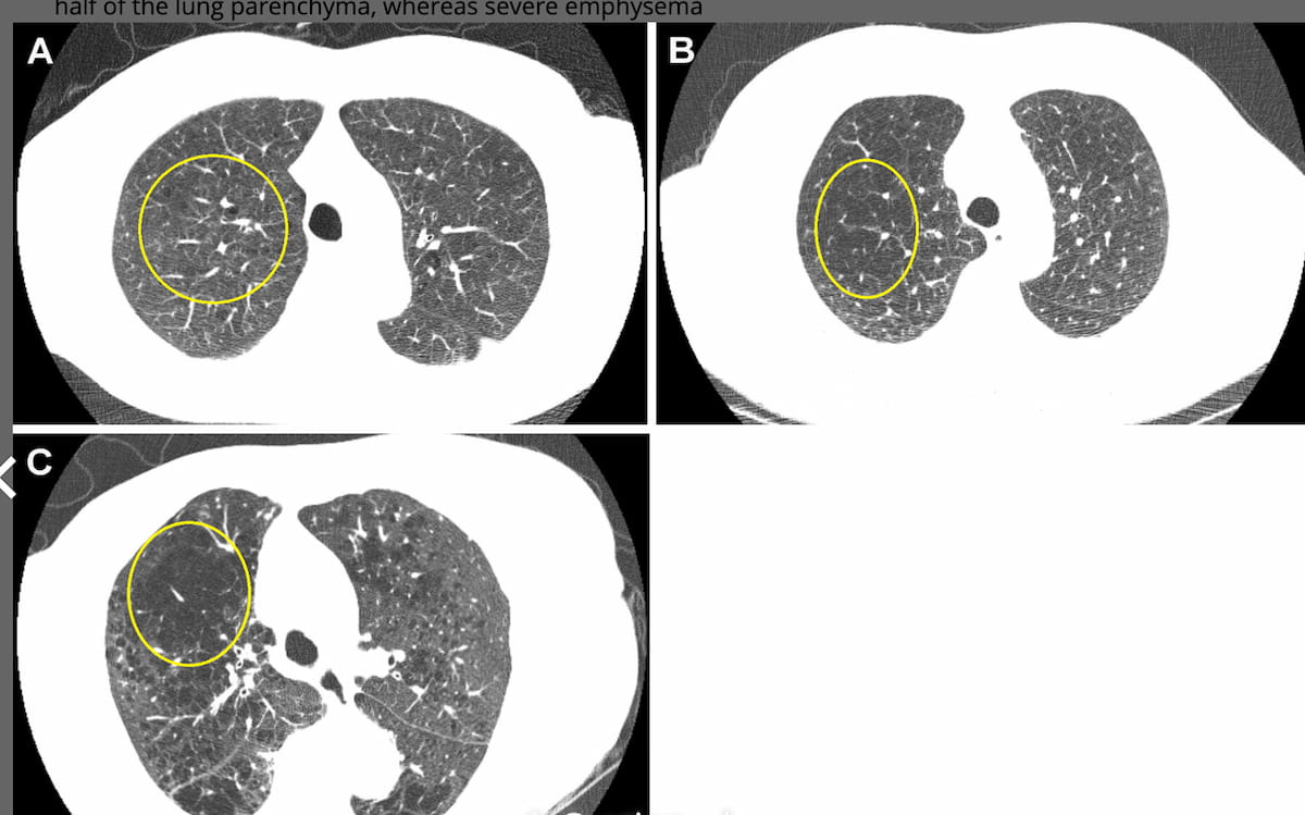 Emphysema on Chest CT Linked to Threefold Higher Risk for COPD Mortality in Next 25 Years