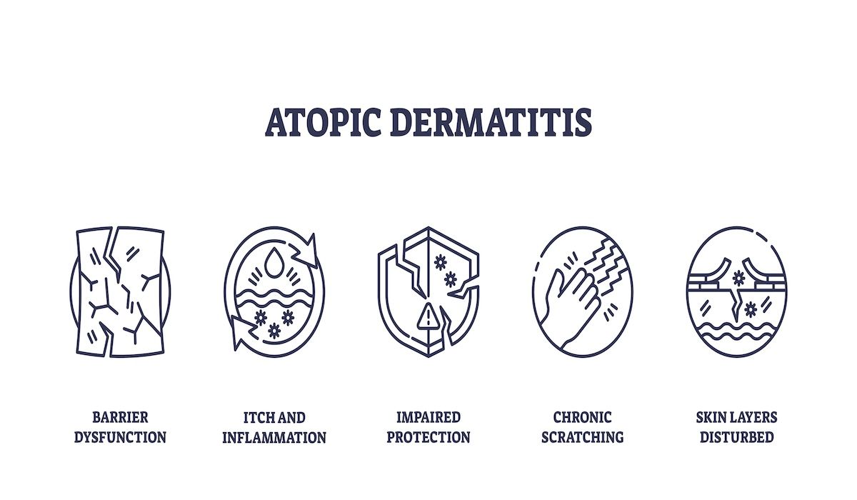 Key Risk Factors Uncovered for AD Recurrence After Dupilumab Discontinuation