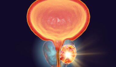 Enrollment goal met in trial of individualized ADT/RT for high-risk prostate cancer