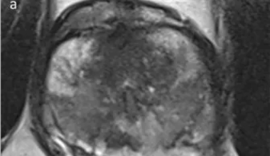 Multicenter Study Finds Abbreviated MRI Non-Inferior to mpMRI for csPCa Detection