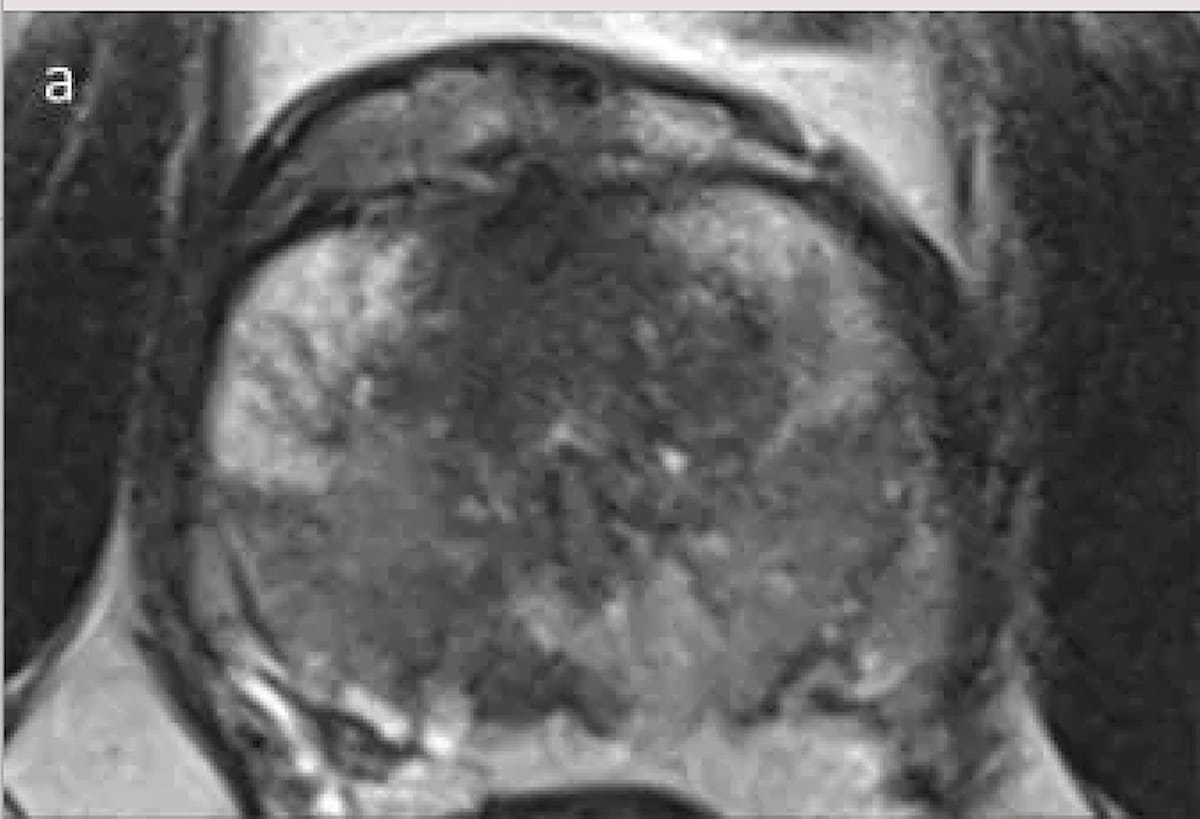 Multicenter Study Finds Abbreviated MRI Non-Inferior to mpMRI for csPCa Detection