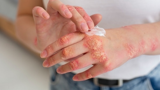 Eczema is a chronic skin condition. 