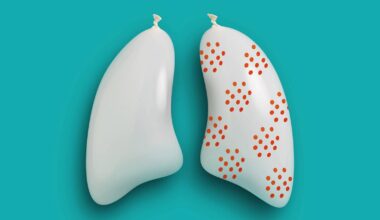 Discovery overturns ideas about small cell lung cancer's start