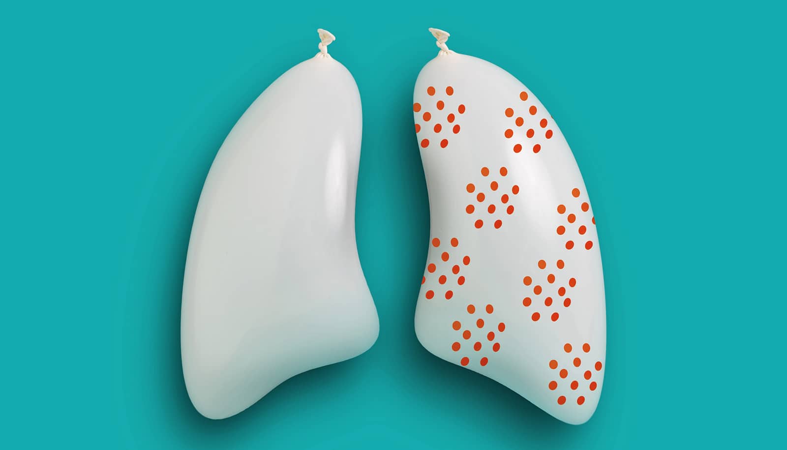 Discovery overturns ideas about small cell lung cancer's start