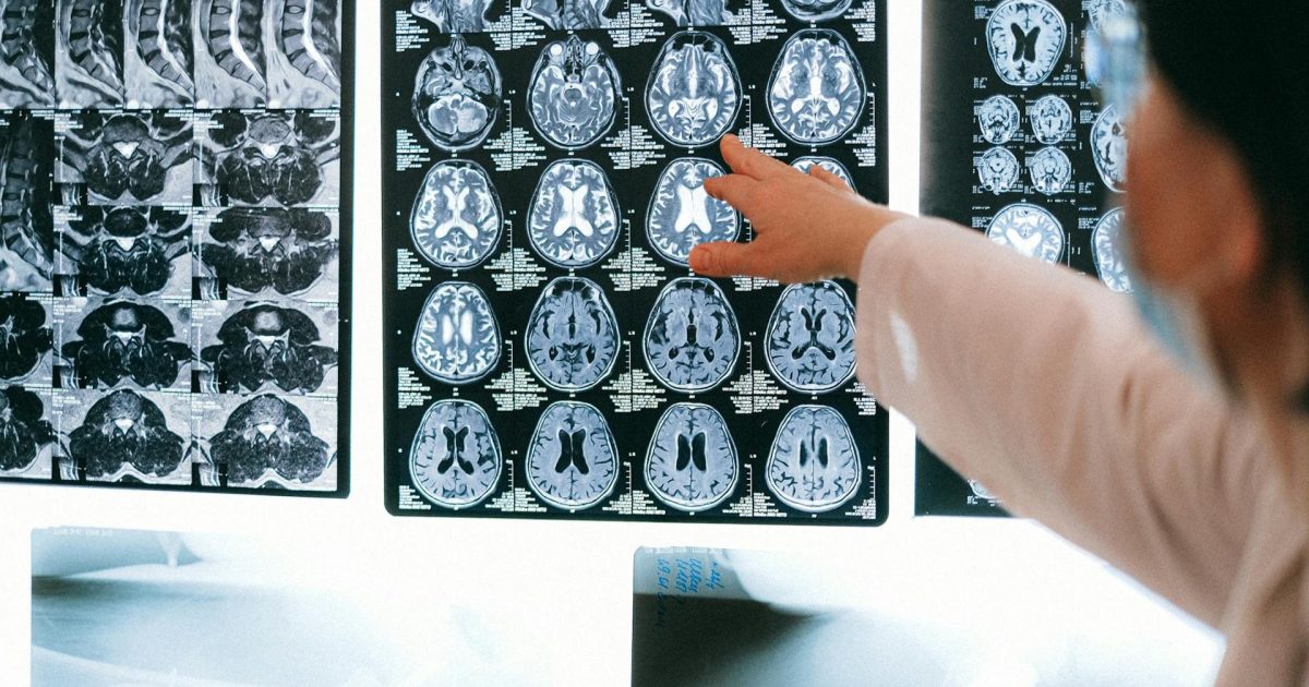Brain scans show this type of exercise boosts memory and grows the hippocampus