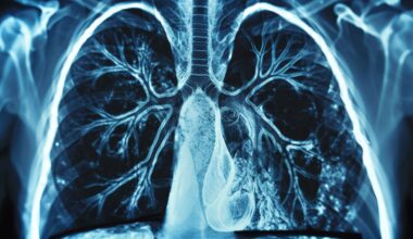 Researchers in China Develop Tool to Detect Hidden Lung Damage in RA Patients