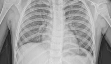 An unusual triad: tuberculomas, tubercular meningitis, and hydrosyringomyelia in a child from a suburban region | International Journal of Emergency Medicine