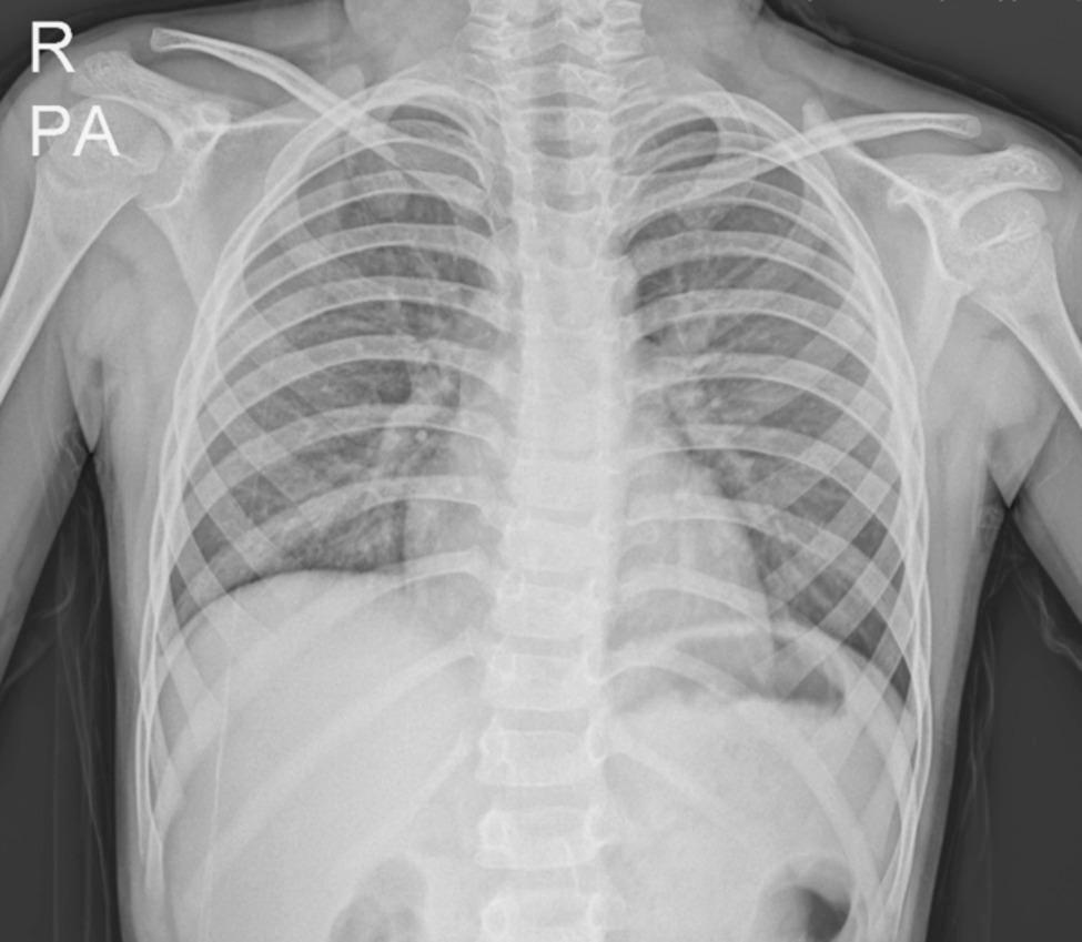 An unusual triad: tuberculomas, tubercular meningitis, and hydrosyringomyelia in a child from a suburban region | International Journal of Emergency Medicine