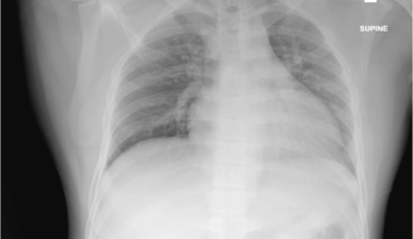 Isolated oculomotor nerve palsy in Neisseria meningitidis meningitis: a case report and literature review | International Journal of Emergency Medicine