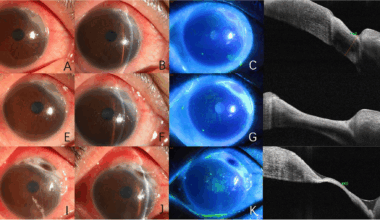 A case report: corneal melting after patch graft in a rheumatoid arthritis patient taking Upadacitinib: paradoxical manifestation or uncontrolled disease activity? | BMC Ophthalmology