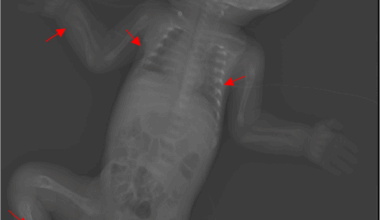 Neonatal hypophosphatasia: a case report of a rare genetic disorder | BMC Pediatrics