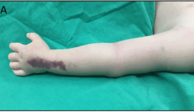 Pediatric necrotizing soft tissue infection: unveiling a rare complication of routine procedures - peripheral venous catheter insertion | BMC Pediatrics