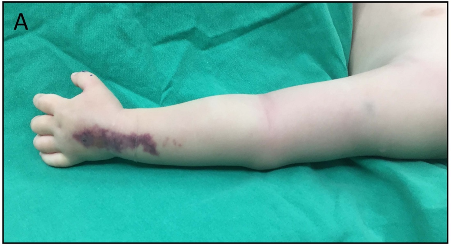 Pediatric necrotizing soft tissue infection: unveiling a rare complication of routine procedures - peripheral venous catheter insertion | BMC Pediatrics