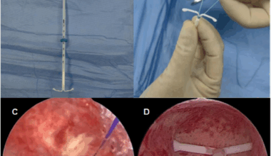 Clinical value of hysteroscopic levonorgestrel intrauterine system suture fixation in treating adenomyosis | BMC Women's Health